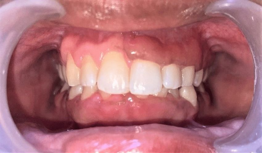 Vitamin D Deficiency And Gingival Enlargement A Case Report