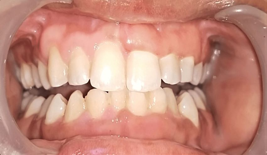 Vitamin D Deficiency And Gingival Enlargement A Case Report