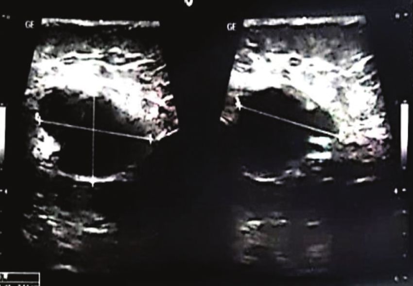 An Unusual Presentation Of Tuberculosis At Atypical Anatomical Location