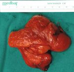 Case Report Giant Posttraumatic Angiolipoma of the Forearm: A Case Report and Review of the Literature - Hindawi.com