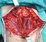 Case Report Giant Posttraumatic Angiolipoma of the Forearm: A Case Report and Review of the Literature - Hindawi.com