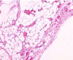 Case Report Giant Posttraumatic Angiolipoma of the Forearm: A Case Report and Review of the Literature - Hindawi.com