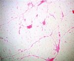 Case Report Giant Posttraumatic Angiolipoma of the Forearm: A Case Report and Review of the Literature - Hindawi.com