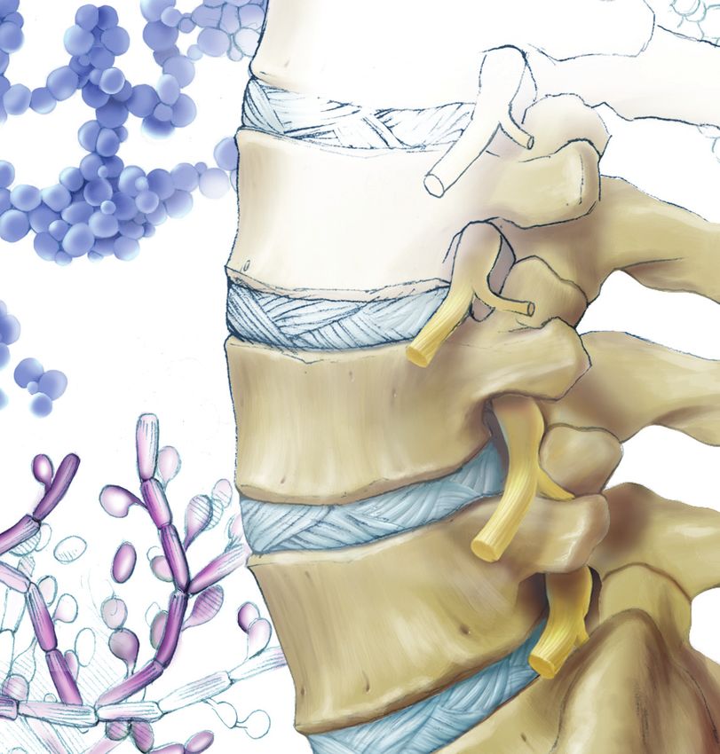 Spinal Infections - North American Spine Society Public Education ...