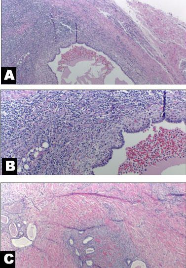 Surgical Management Of Inguinal Endometriosis Case Report And Surgical