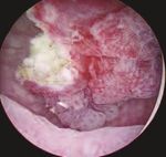 Endoscopic laser en bloc removal of bladder tumor. Surgical radicality and improvement of the pathological diagnostic accuracy