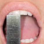 Dental advice for patients having radiotherapy and chemotherapy for head and neck cancer