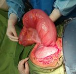 A Case of Sigmoid Volvulus in Pregnancy: A Rare Emergency in Pregnancy - International Journal of Pediatrics