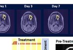 Case Report: End-Stage Recurrent Glioblastoma Treated With a New Noninvasive Non-Contact Oncomagnetic Device - Frontiers