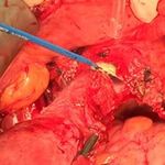 Abdominal hysterectomy versus total laparoscopic hysterectomy in cases of enlarged uterine size