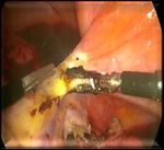 Abdominal hysterectomy versus total laparoscopic hysterectomy in cases of enlarged uterine size