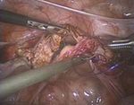 Abdominal hysterectomy versus total laparoscopic hysterectomy in cases of enlarged uterine size