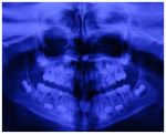 Management of large inflammatory dentigerous cysts adapted to the general condition of the patient: Two case reports