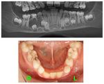 Management of large inflammatory dentigerous cysts adapted to the general condition of the patient: Two case reports