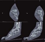 Comminuted navicular fracture treated with an internal fixation plate - Technical Tip