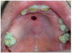 Rare Iatrogenic Oronasal Communication after Superior Canine Odontectomy Attempt