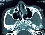 Middle Turbinate mucocele: An unusual location - Journal ...