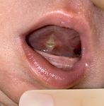 POST-OP FRENECTOMY HOME CARE GUIDE - Dr. Chelsea Pinto