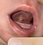 POST-OP FRENECTOMY HOME CARE GUIDE - Dr. Chelsea Pinto