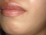 Case Report Lip Epidermoid Cyst Caused by a Piercing: A Report of a Rare Case - Hindawi.com