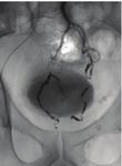 Emborrhoid Technique for Chronic Hemorrhoidal Disease: Where Do We Stand? - Endovascular Today