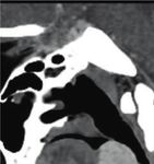 Case Report Lingual Thyroid with Subclinical Hypothyroidism in a Young Female