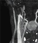 Case Report Lingual Thyroid with Subclinical Hypothyroidism in a Young Female