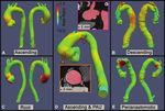 Vascular Deformation Mapping for CT Surveillance of Thoracic Aortic ...