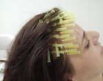 Scalp threading - new treatment option for Androgenetic Alopecia - new treatment option for Androgenetic ...