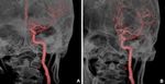 Eagle syndrome with hidden stylocarotid syndrome examined using dynamic ultrasonography: illustrative case