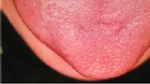 Case Report Parosmia, Dysgeusia, and Tongue Features Changes in a Patient with Post-Acute COVID-19 Syndrome