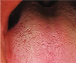 Case Report Parosmia, Dysgeusia, and Tongue Features Changes in a Patient with Post-Acute COVID-19 Syndrome