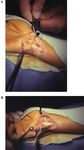 Clinical Features of Ulnar Tunnel Syndrome and the Diagnostic Value of Nerve Conduction Measurements