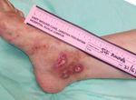 A unique, multifunctional dressing in chronic wound management - Wounds International