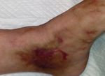 A unique, multifunctional dressing in chronic wound management - Wounds International