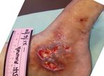 A unique, multifunctional dressing in chronic wound management - Wounds International