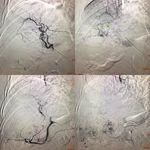 New Frontiers In Endovascular Therapies For Locally Advanced ...