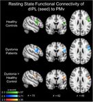The role of the inferior parietal lobule in writer's cramp