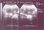 Rare Presentation of Chorioadenoma Destruens as Acute Haemoperitoneum Mimicking Ruptured Ectopic Pregnancy