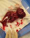 Conjoined Twins-Cephalo-Thoraco-Omphalopagus: A Case Report - Bahrain Medical Bulletin