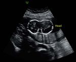 Conjoined Twins-Cephalo-Thoraco-Omphalopagus: A Case Report - Bahrain Medical Bulletin