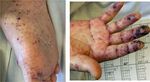 HEPARIN-INDUCED THROMBOCYTOPENIA DURING IGA VASCULITIS: A CASE REPORT