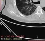 Case Report Rhabdomyolysis plus Hypocalcemia and Diabetic Ketoacidosis as Concurrent Rare COVID-19 Manifestations