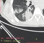 Case Report Rhabdomyolysis plus Hypocalcemia and Diabetic Ketoacidosis as Concurrent Rare COVID-19 Manifestations