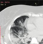 Case Report Rhabdomyolysis plus Hypocalcemia and Diabetic Ketoacidosis as Concurrent Rare COVID-19 Manifestations