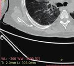 Case Report Rhabdomyolysis plus Hypocalcemia and Diabetic Ketoacidosis as Concurrent Rare COVID-19 Manifestations