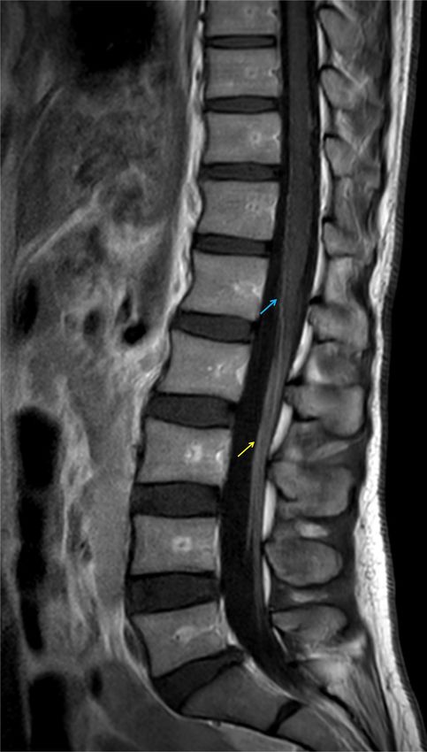 GUILLAIN-BARRE SYNDROME FOLLOWING THE FIRST DOSE OF THE CHIMPANZEE