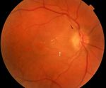 Stellar Neuroretinitis Revealing a Lyme Disease: Case Report