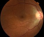 Stellar Neuroretinitis Revealing a Lyme Disease: Case Report