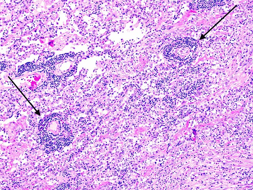 A 49-Year-Old Woman Presenting With Cavitary Lung Lesions: A Case Report